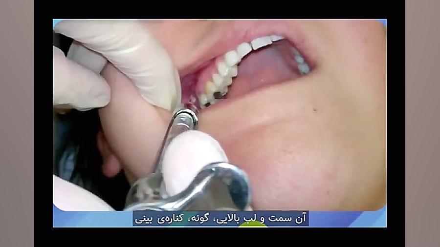 تزریق بی حسی ماگزیلا کامپوزیت ونیر