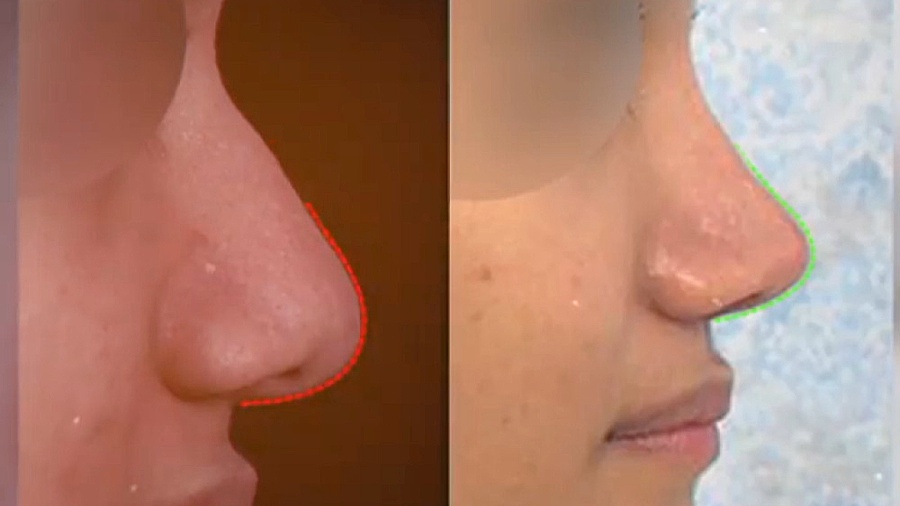 جراحی بینی گوشتی دکتر علی باقری حق