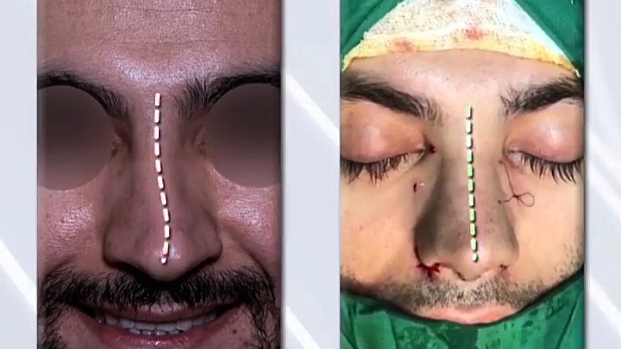 جراحی زیبایی بینی با دکتر علی باقری حق دکتر علی باقری حق
