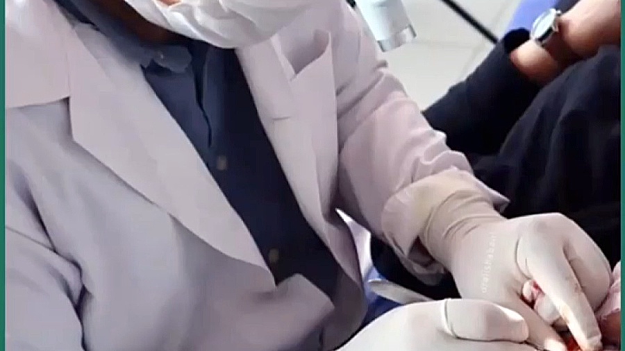 جراحی پلک با بیحسی موضعی پیلینگ شیمیایی