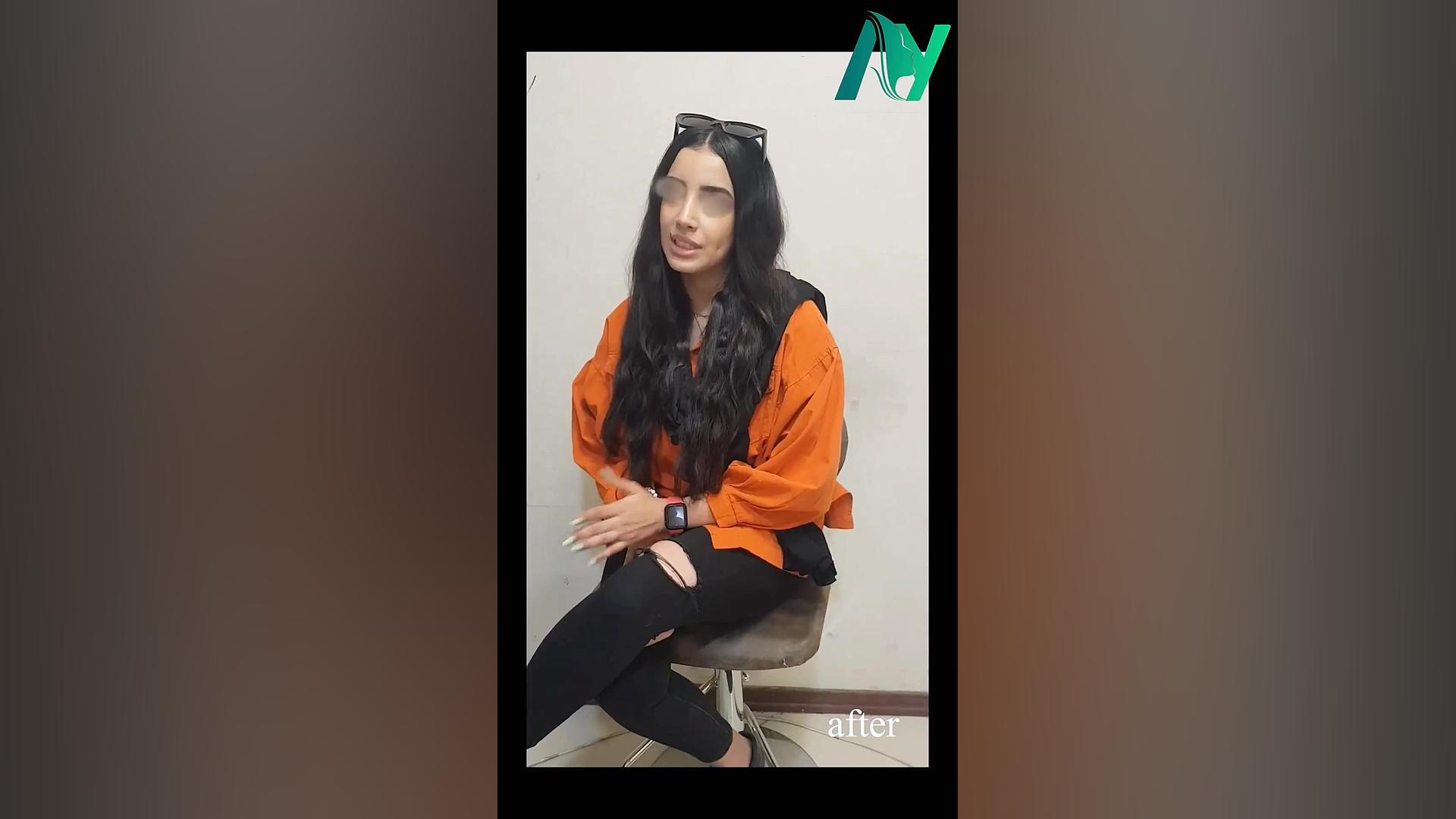 سه سال بعد از جراحی رینوپلاستی دکتر محمودرضا اصحاب یمین - فوق تخصص پلاستیک