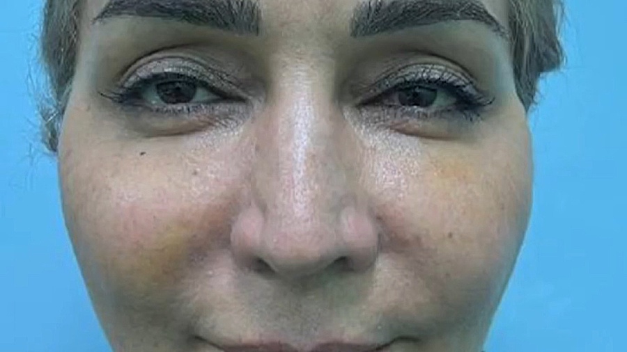 جوانسازی کل صورت با تزریق چربی دکتر شاهین بهجو - فوق تخصص جراحی پلاستیک