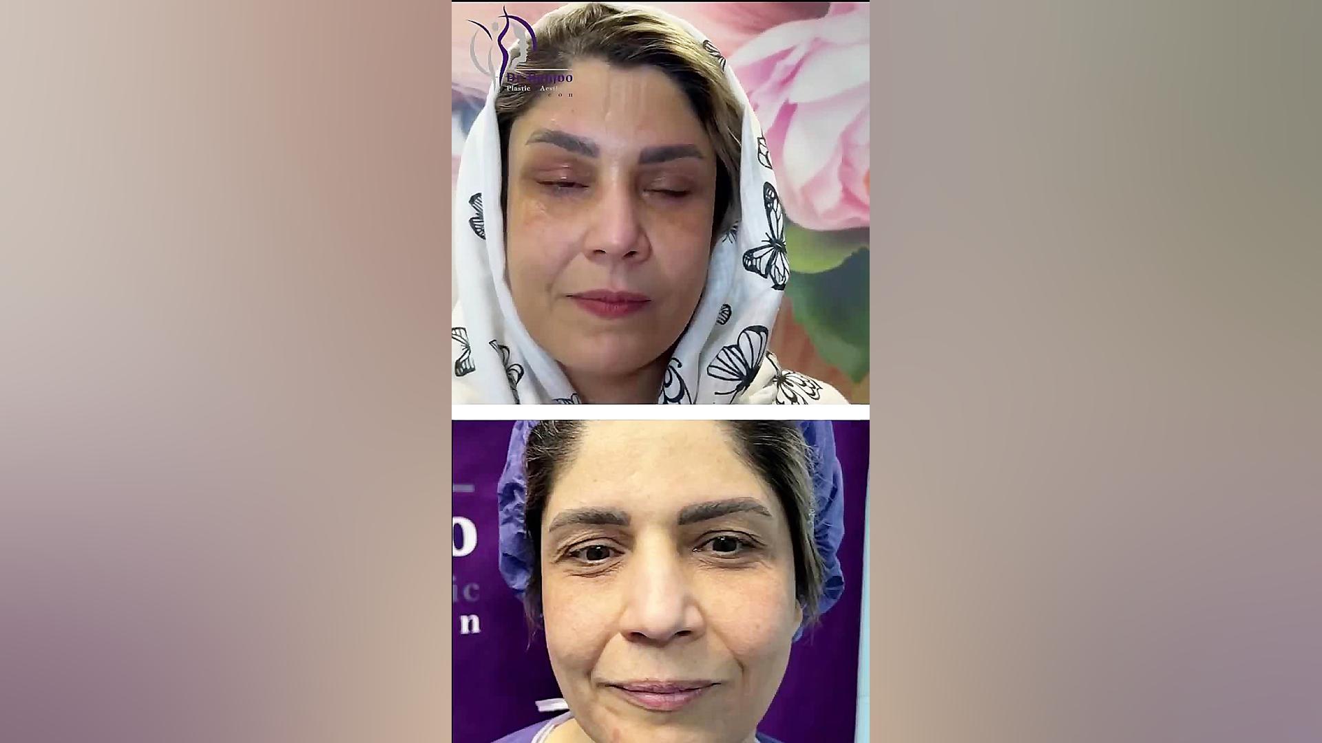 ۱۱ روز بعد از لیفت اندوسکوپی پیشانی و بلفاروپلاستی پلک فوقانی و تحتانی دکتر شاهین بهجو - فوق تخصص جراحی پلاستیک