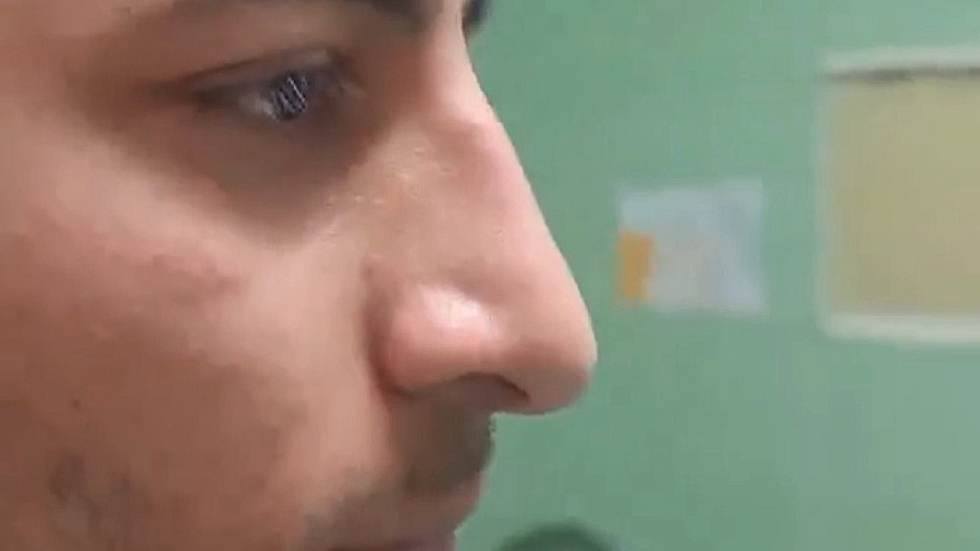 جراحی بینی مردانه دکتر شاهین بهجو - فوق تخصص جراحی پلاستیک