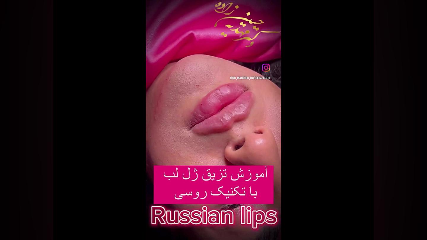 تزریق لب روسی در ایران کلینیک زیبایی رشت دکتر مهدیه حسین زاده
