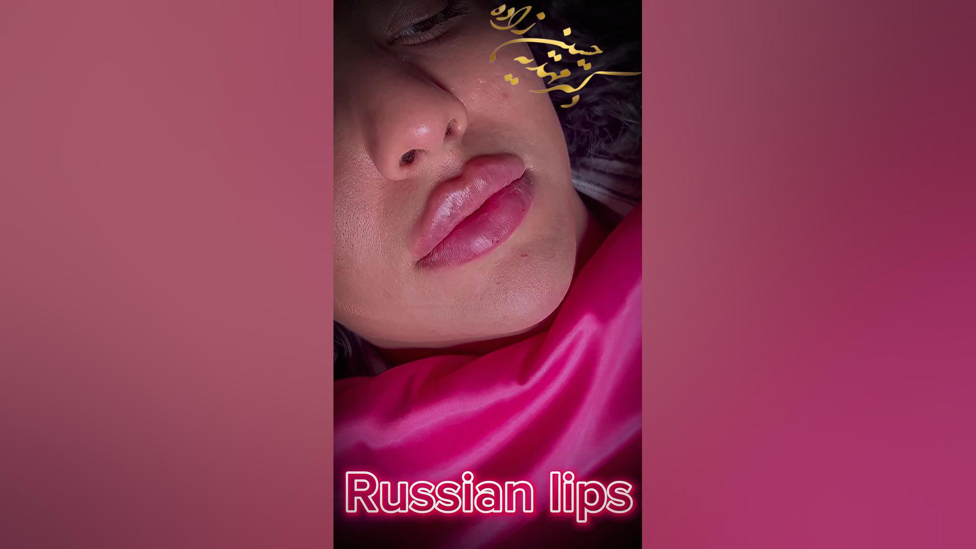 تزریق لب روسی در رشت دکتر مهدیه حسین زاده کلینیک زیبایی رشت دکتر مهدیه حسین زاده