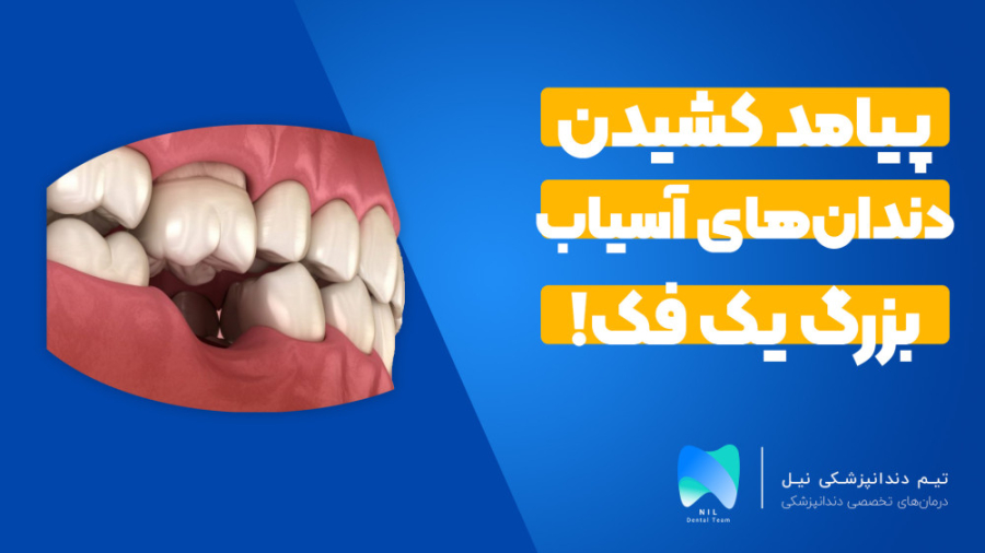 پیامد کشیدن دندان‌های آسیاب بزرگ یک فک پر کردن دندان
