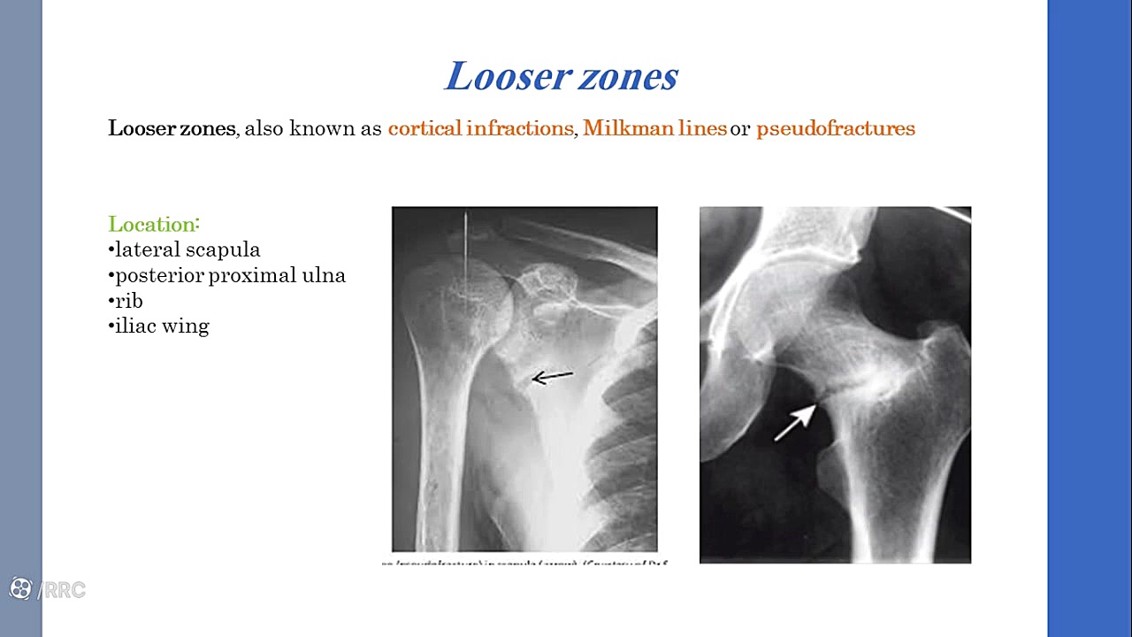 Osteomalacia Paget Disease ابرسانی پوست