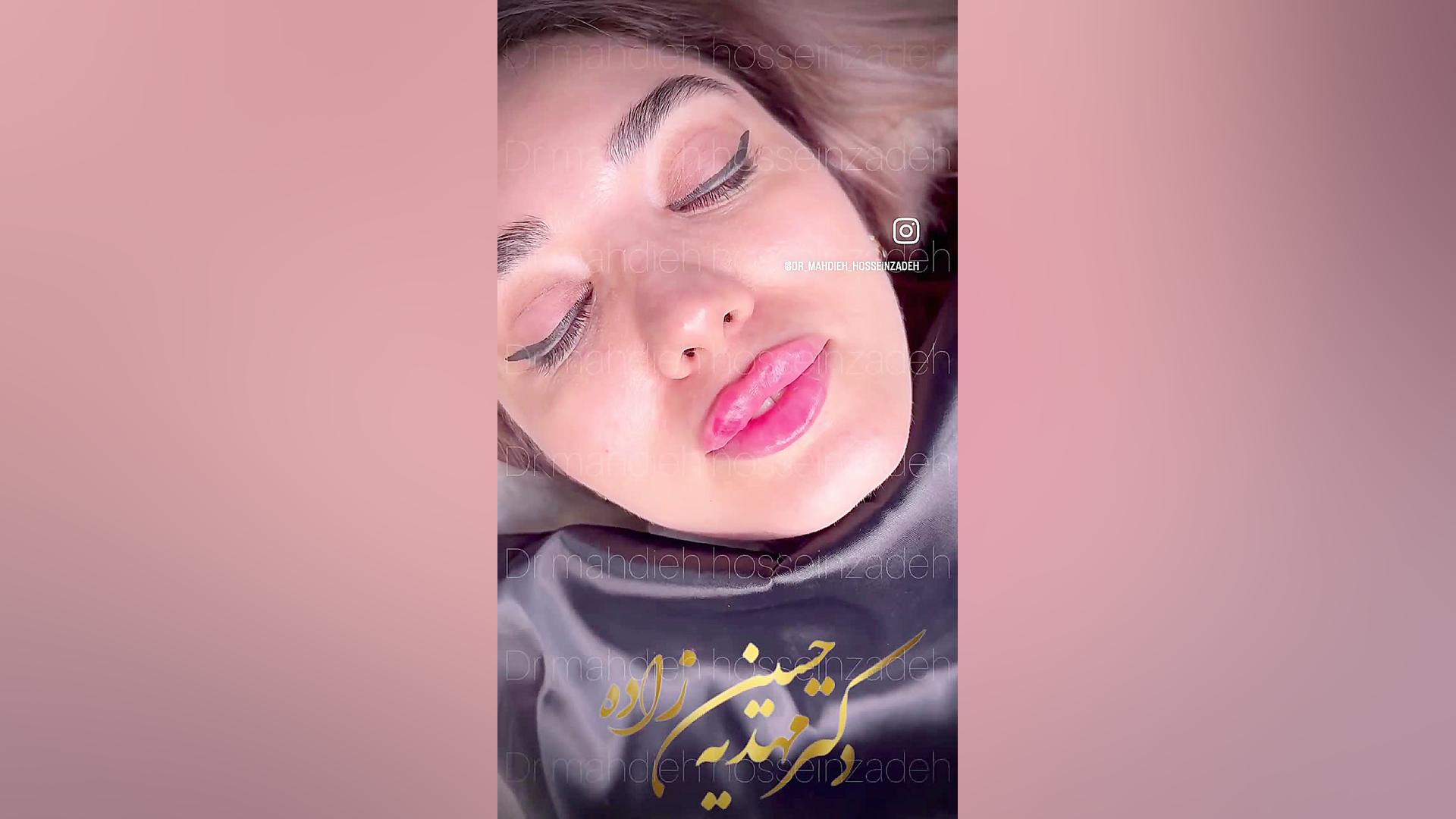 تزریق ژل لب با تکنیک روسی در رشت کلینیک زیبایی رشت دکتر مهدیه حسین زاده