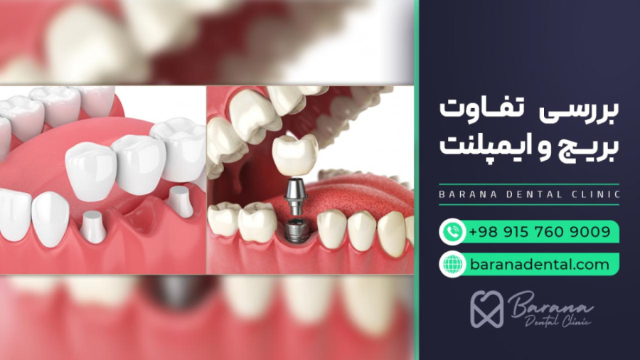 "بریج دندان بهتر است یا ایمپلنت؟" Förster Resonance Energy Transfer Test