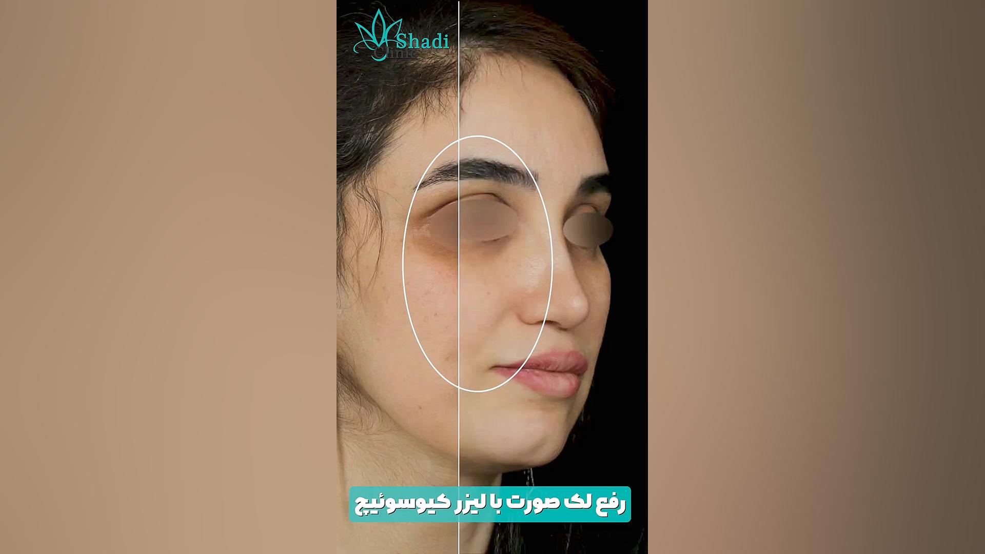 درمان لک صورت در یک جلسه ترمیم ونیر