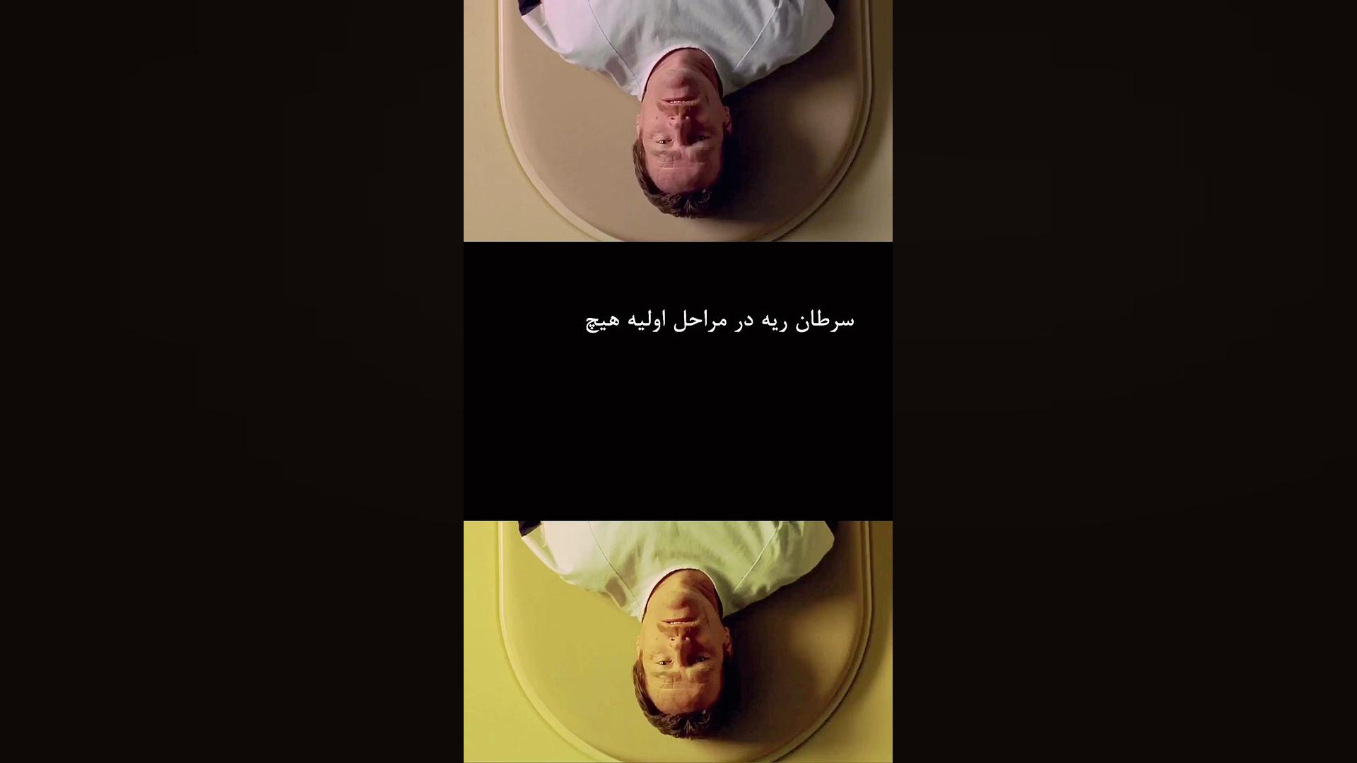 سرطان ریه کشنده ترین سرطان در انسان اتوپلاستی