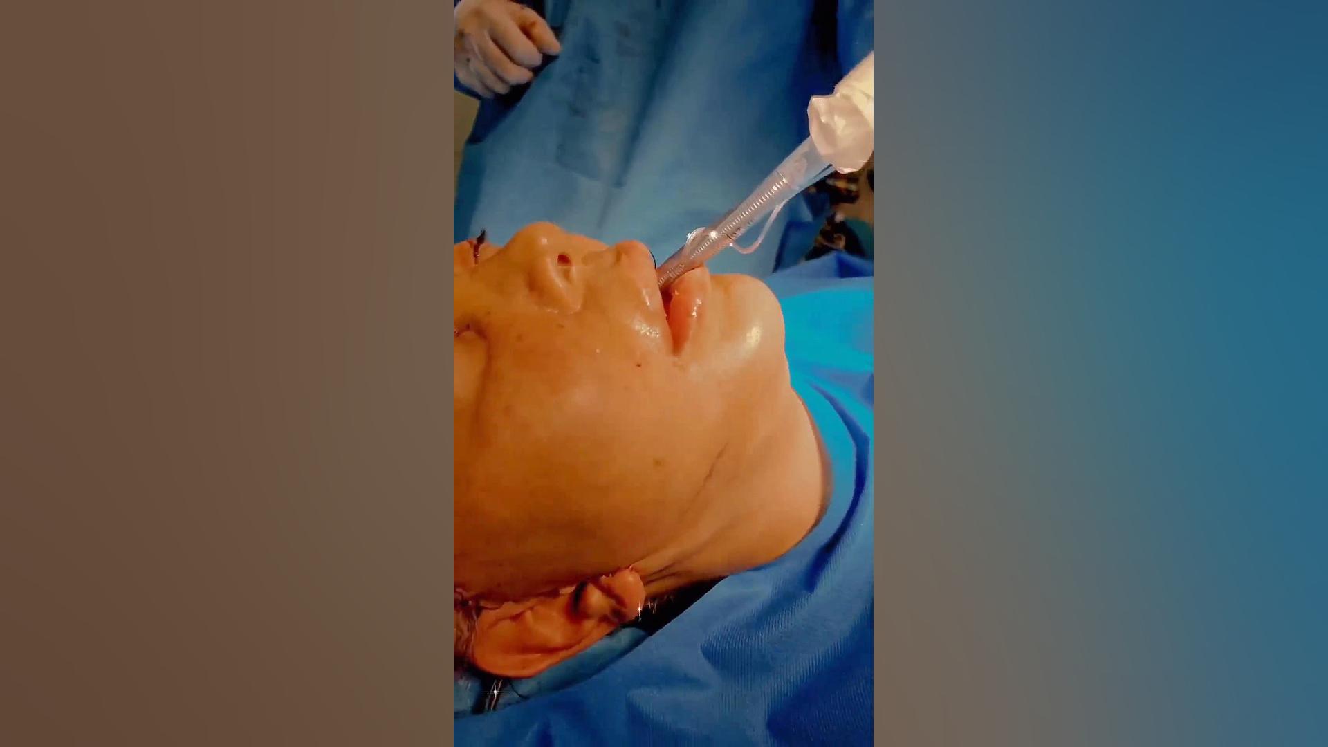 لیفت آندوسکوپی ابرو و شقیقه و لیفت کامل صورت و گردن مهندسی ژنوم انسانی
