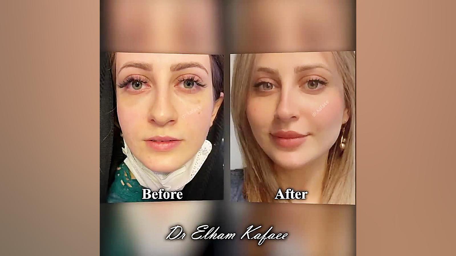 9 ماه پس از تزریق ژل لب و تزریق چربی به صورت ویروس‌شناسی پیشرفته