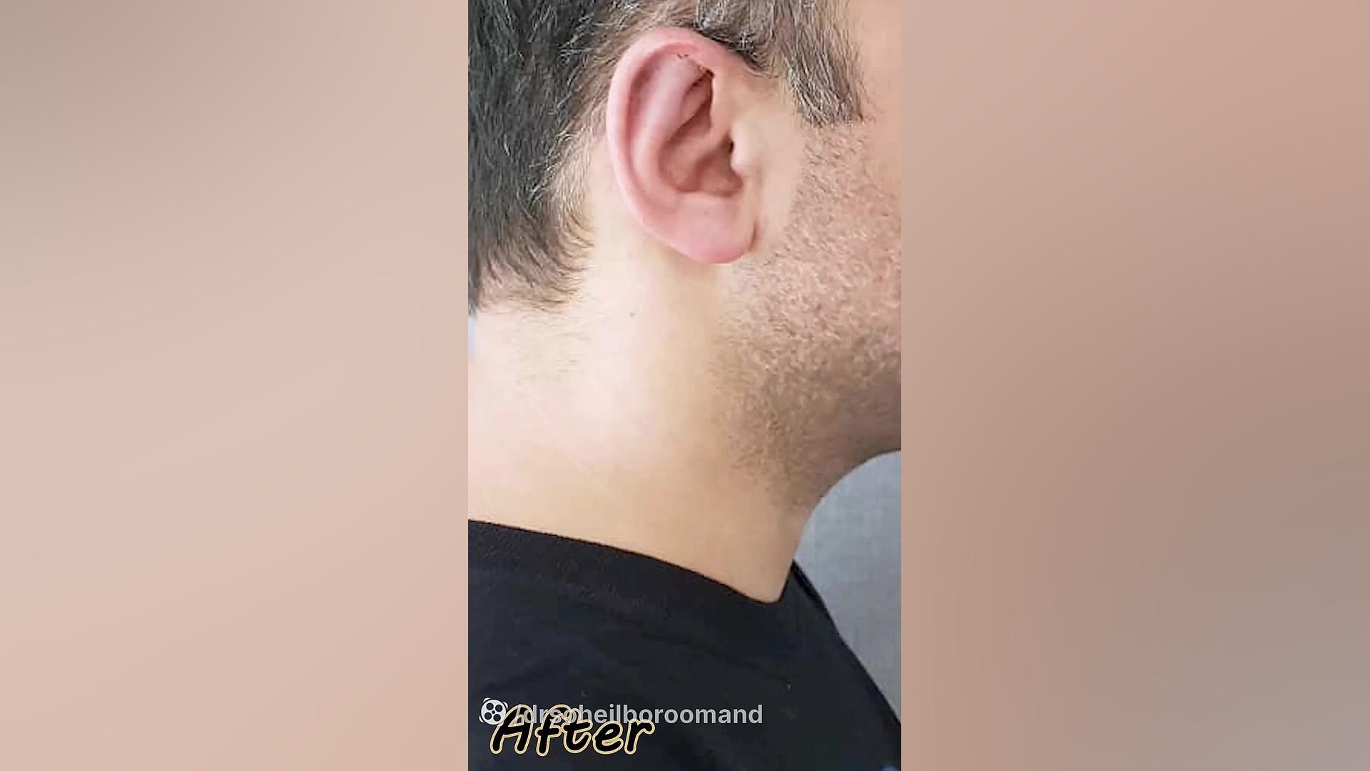نتیجه جراحی زیبایی گوش کرانیوسینوستوز