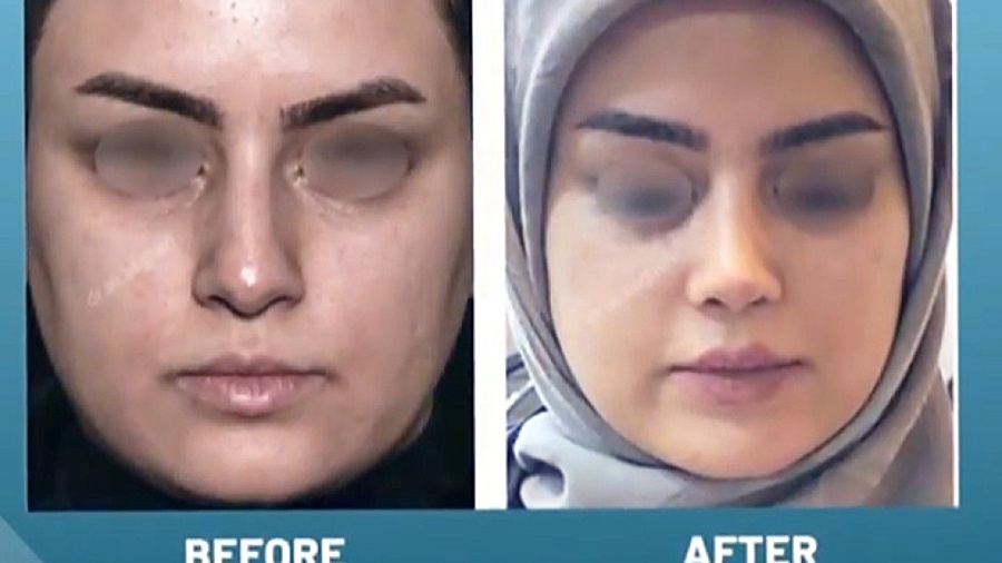 رینوپلاستی در بانوان دکتر علی باقری حق