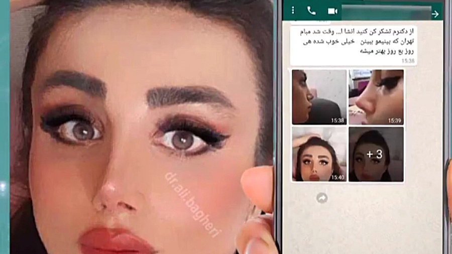 رضایت زیبا جو از عمل بینی دکتر علی باقری حق