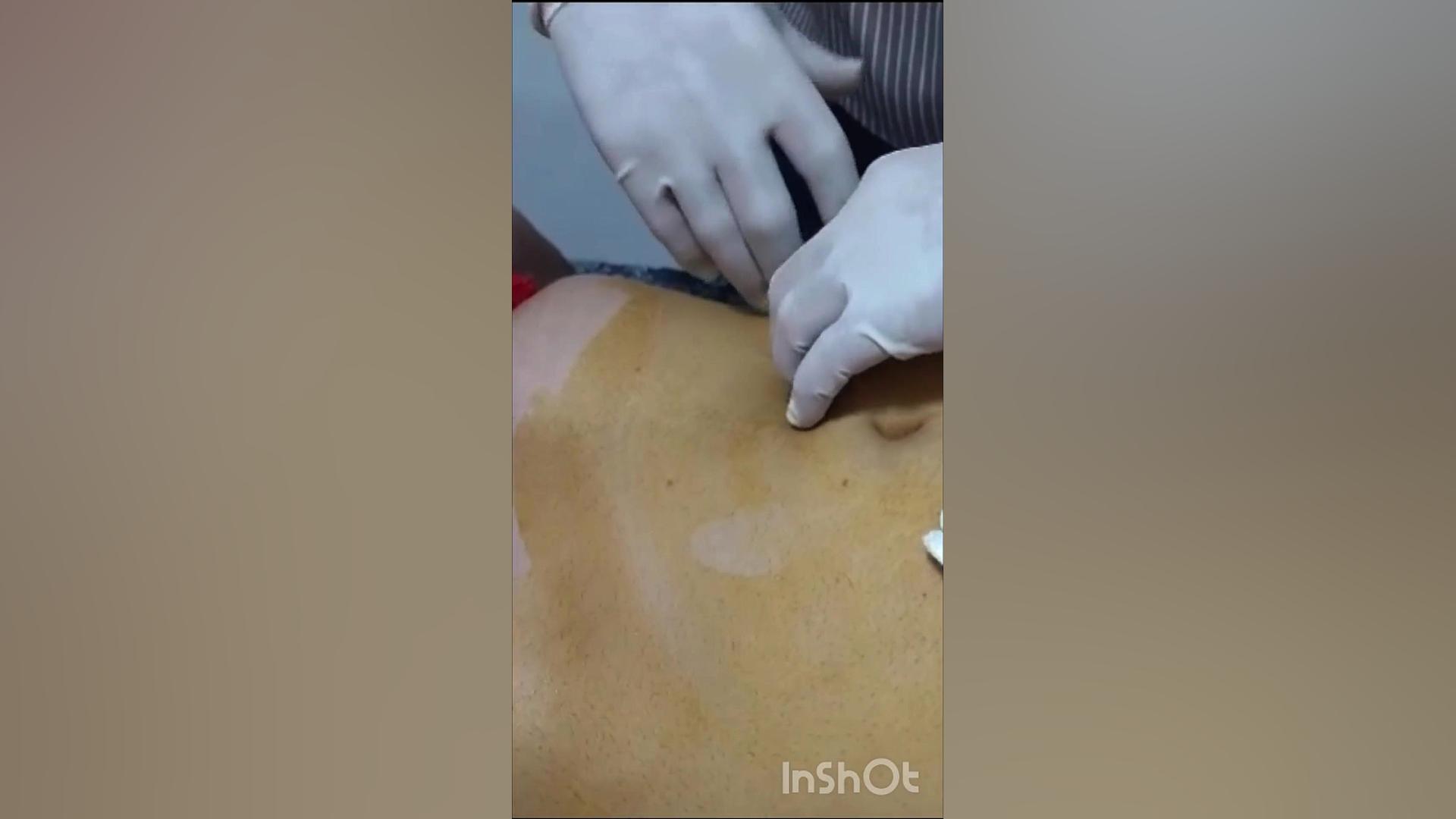 امبدینگ شکم جهت لاغری موضعی دکتر بابک محمودی
