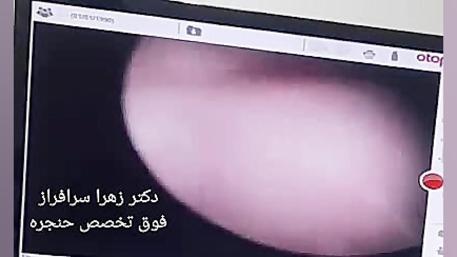 بهترین جراح حنجره در تهران، دکتر زهرا سرافراز برداشتن توده