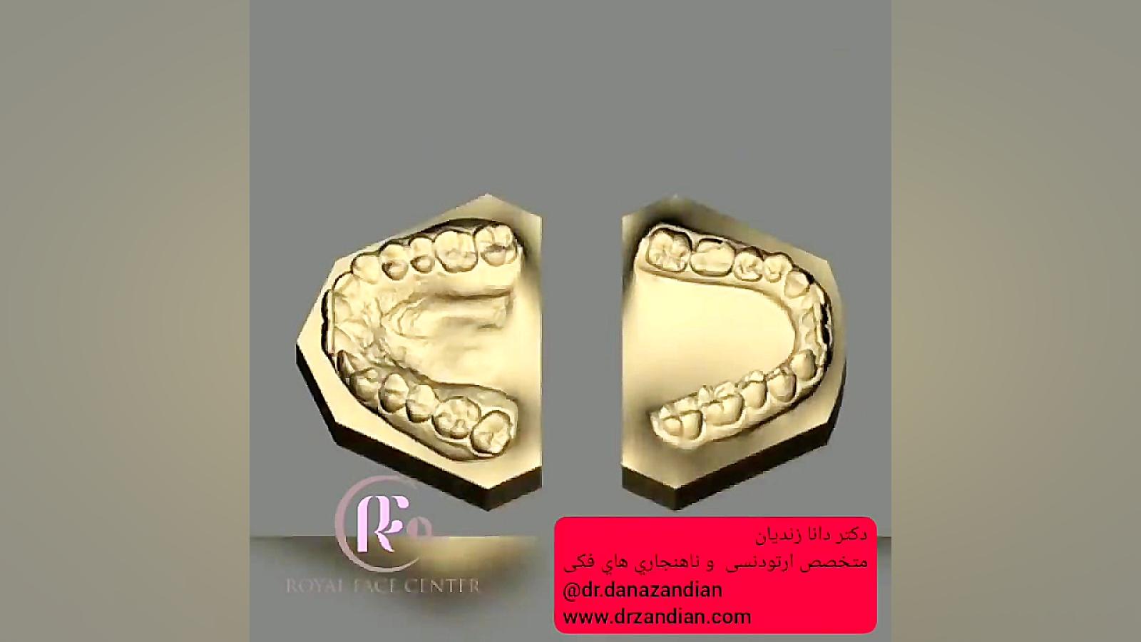 درباره الاینرهای ارتودنسی نامرئی دکتر دانا زندیان