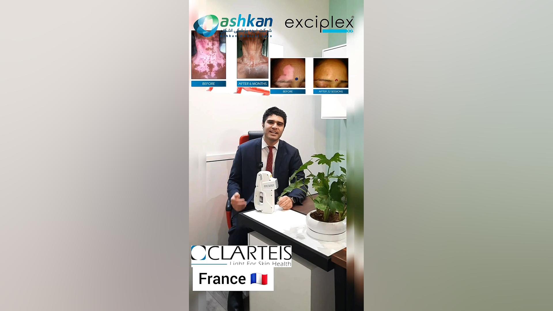 اگزایمر، ویتلیگو، پسوریازیس ، ریزش سکه ای مو، پیسی ، اگزما exciplex برداشتن خال