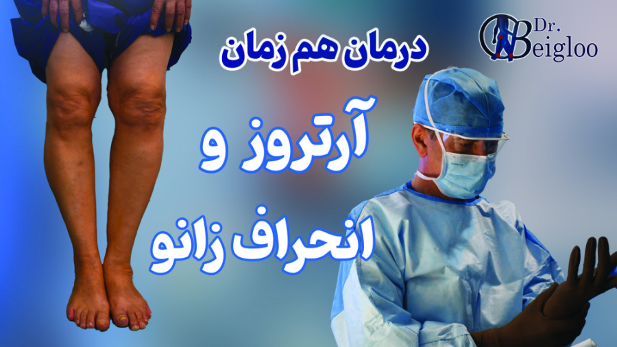 درمان همزمان آرتروز شدید و انحراف زانو دکتر محمود جعفر بیگلو