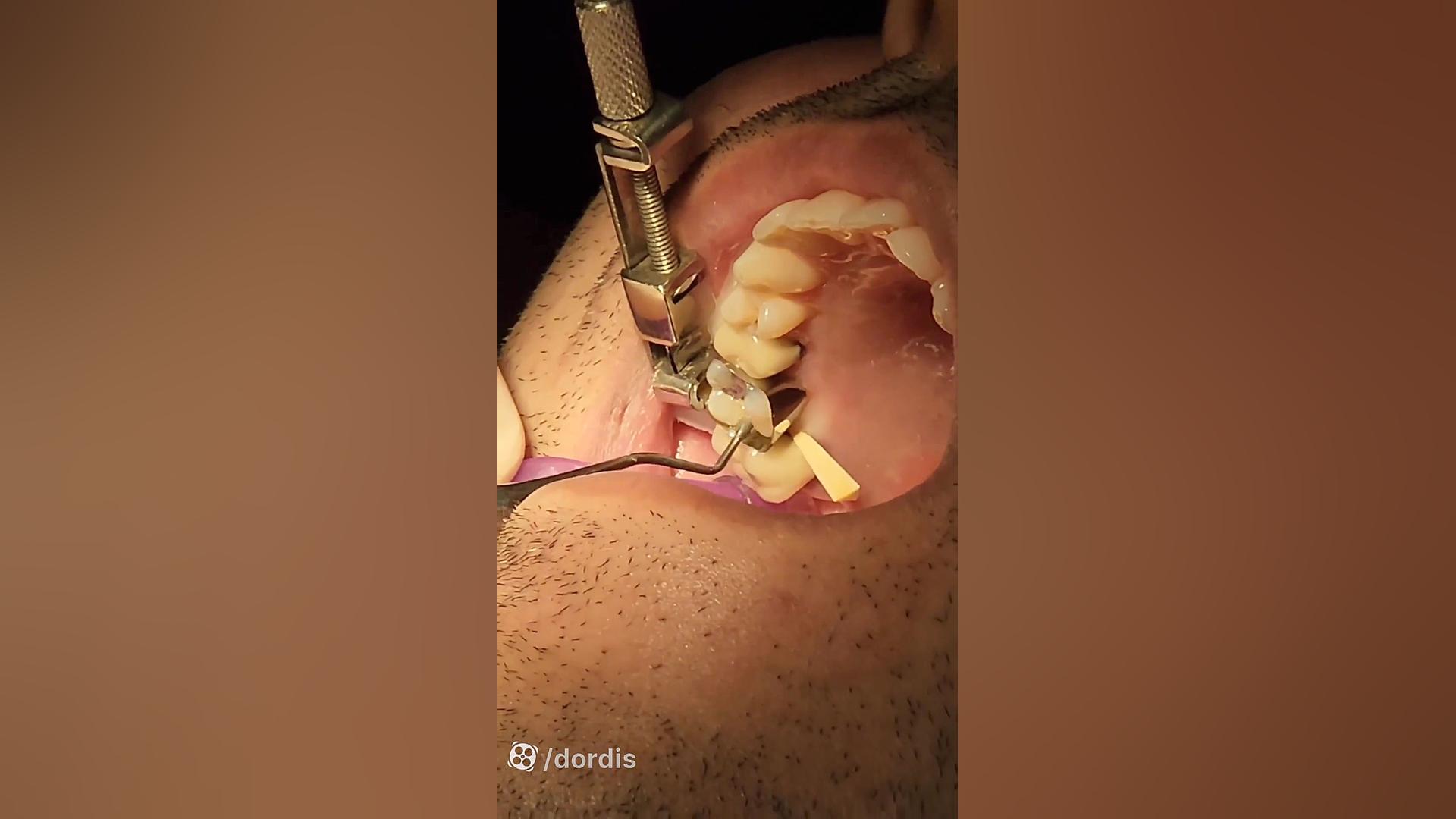 فیلم ترمیم دندان های پوسیده Microarray