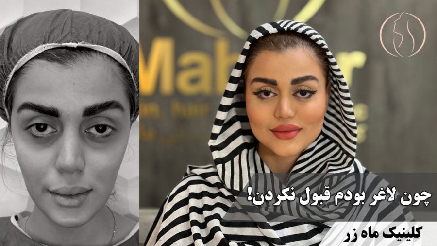 رویای زیبایی با تزریق چربی بایوفت ( کلینیک ماه زر ) کولفی‌تیل