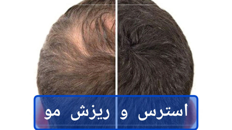 تاثیر سیگار و استرس بر ریزش مو دکتر ریحانه مهرگان