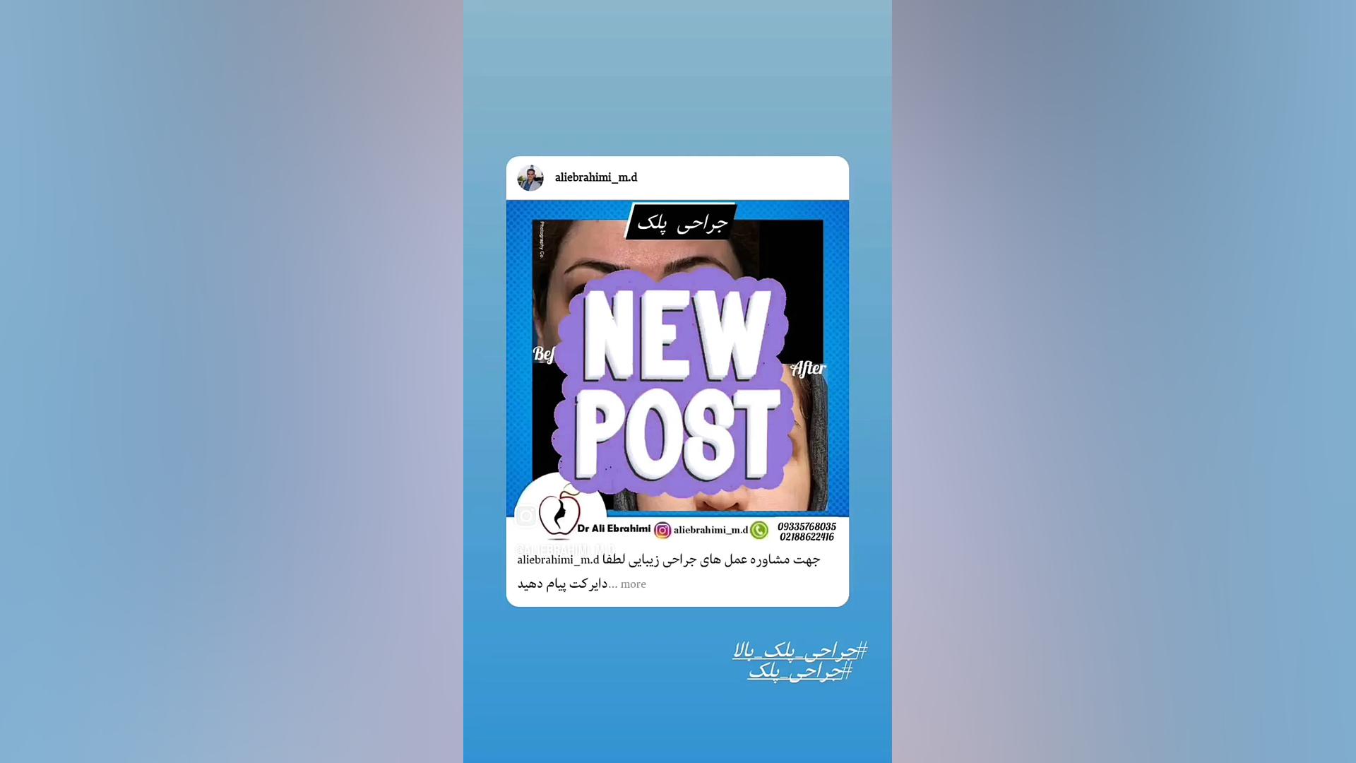 جرای زیبایی پلک دکتر علی ابراهیمی فوق تخصص جراحی پلاستیک .