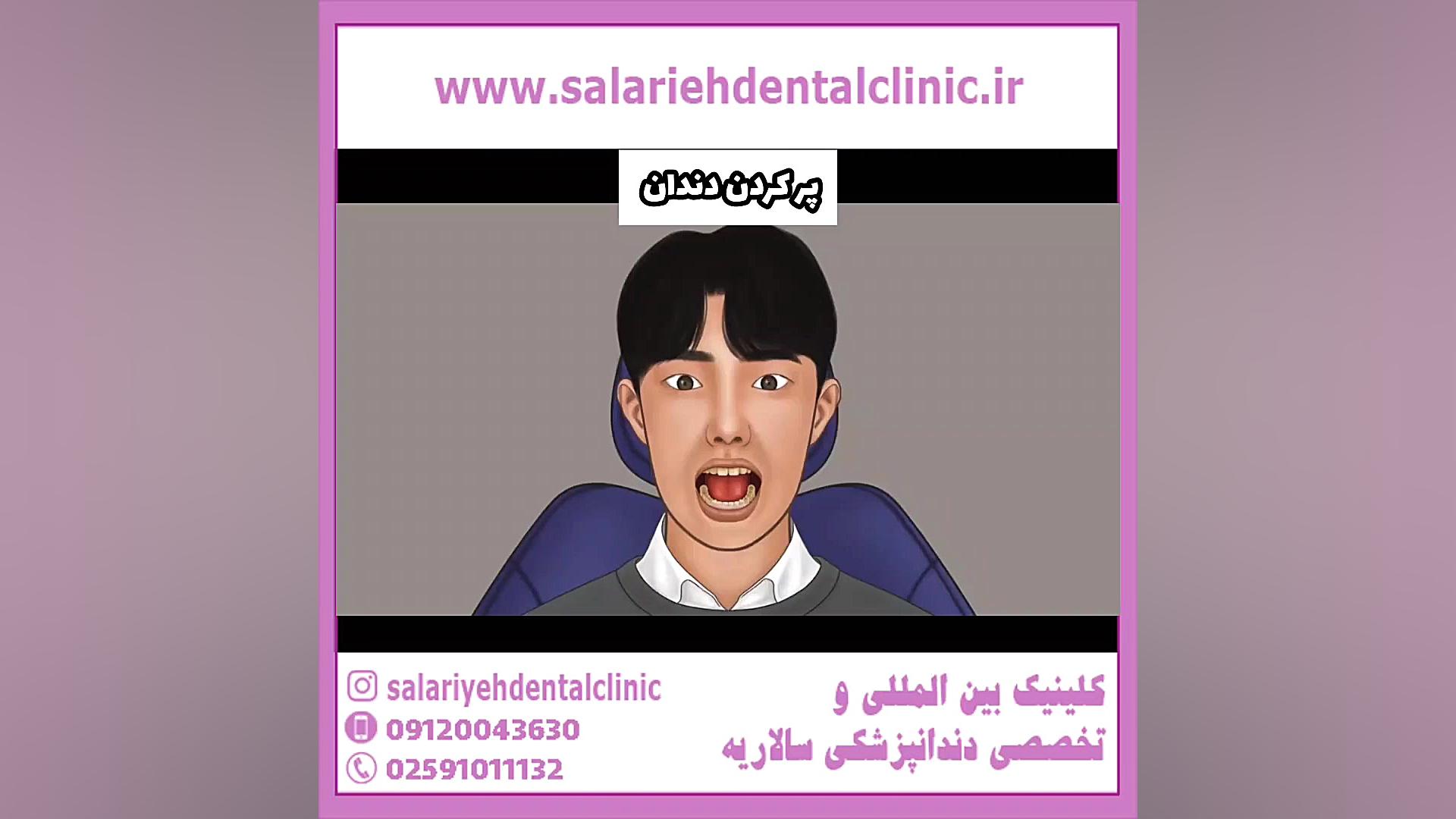 ایا پرکردن دندان خوب است دندان مصنوعی