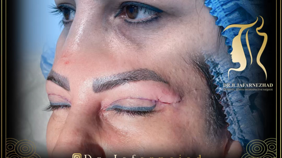 نمونه کار جراحی بلفاروپلاستی دکتر بابک جعفرنژاد دکتر بابک جعفرنژاد