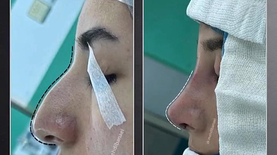 قبل و بعد از عمل بینی