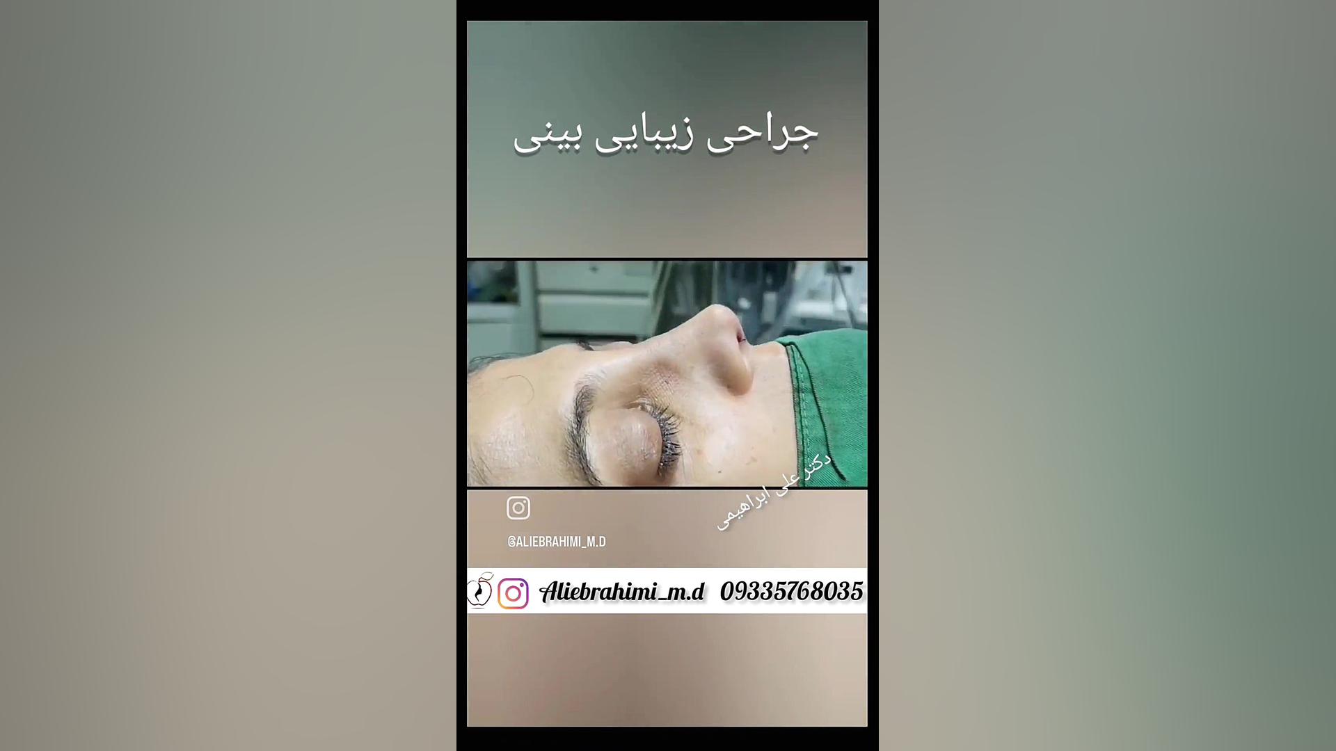 جراحی زیبایی بینی دکتر علی ابراهیمی فوق تخصص جراحی پلاستیک .