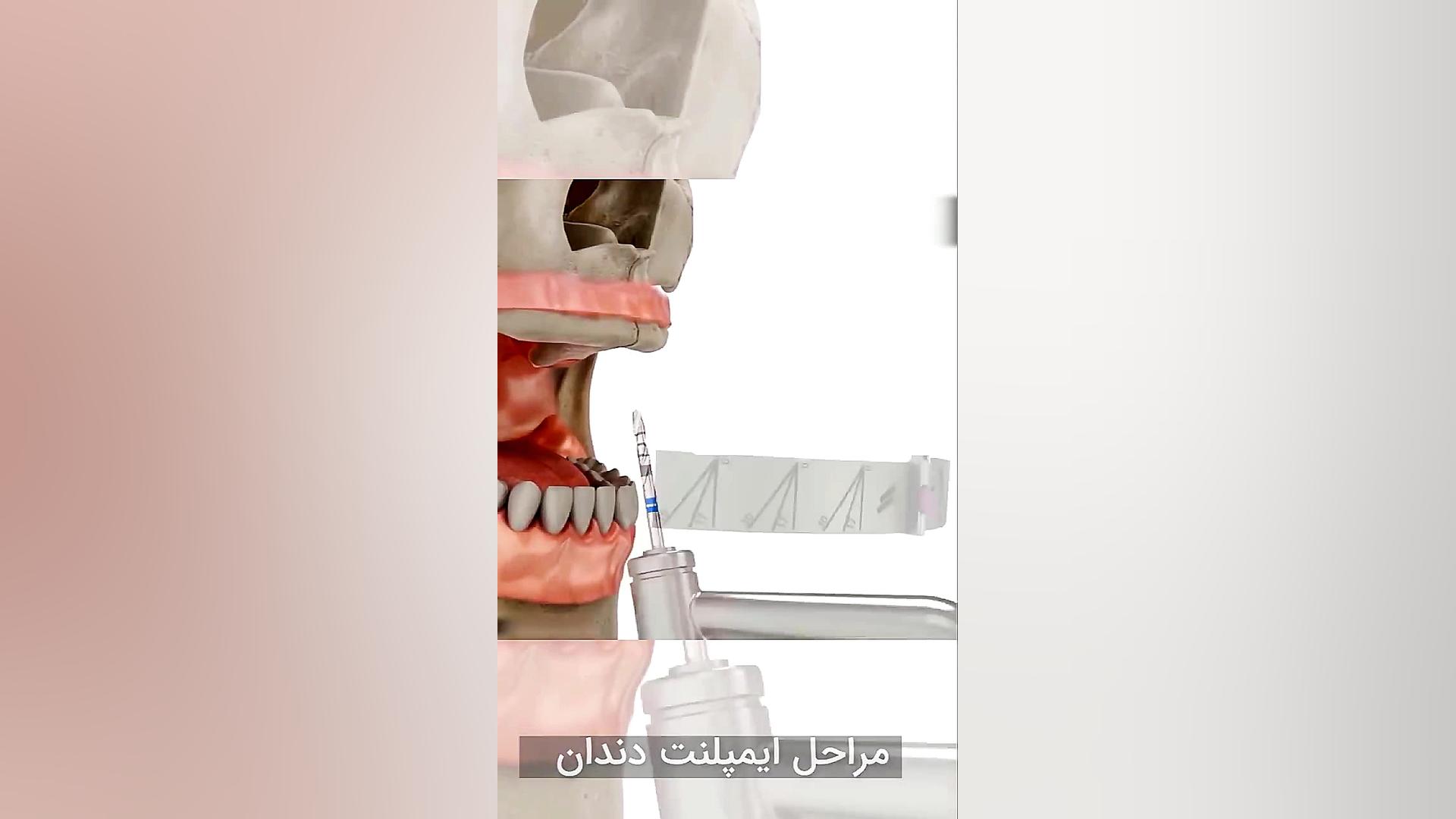 مراحل ایمپلنت دندان تست مهار دگزامتازون