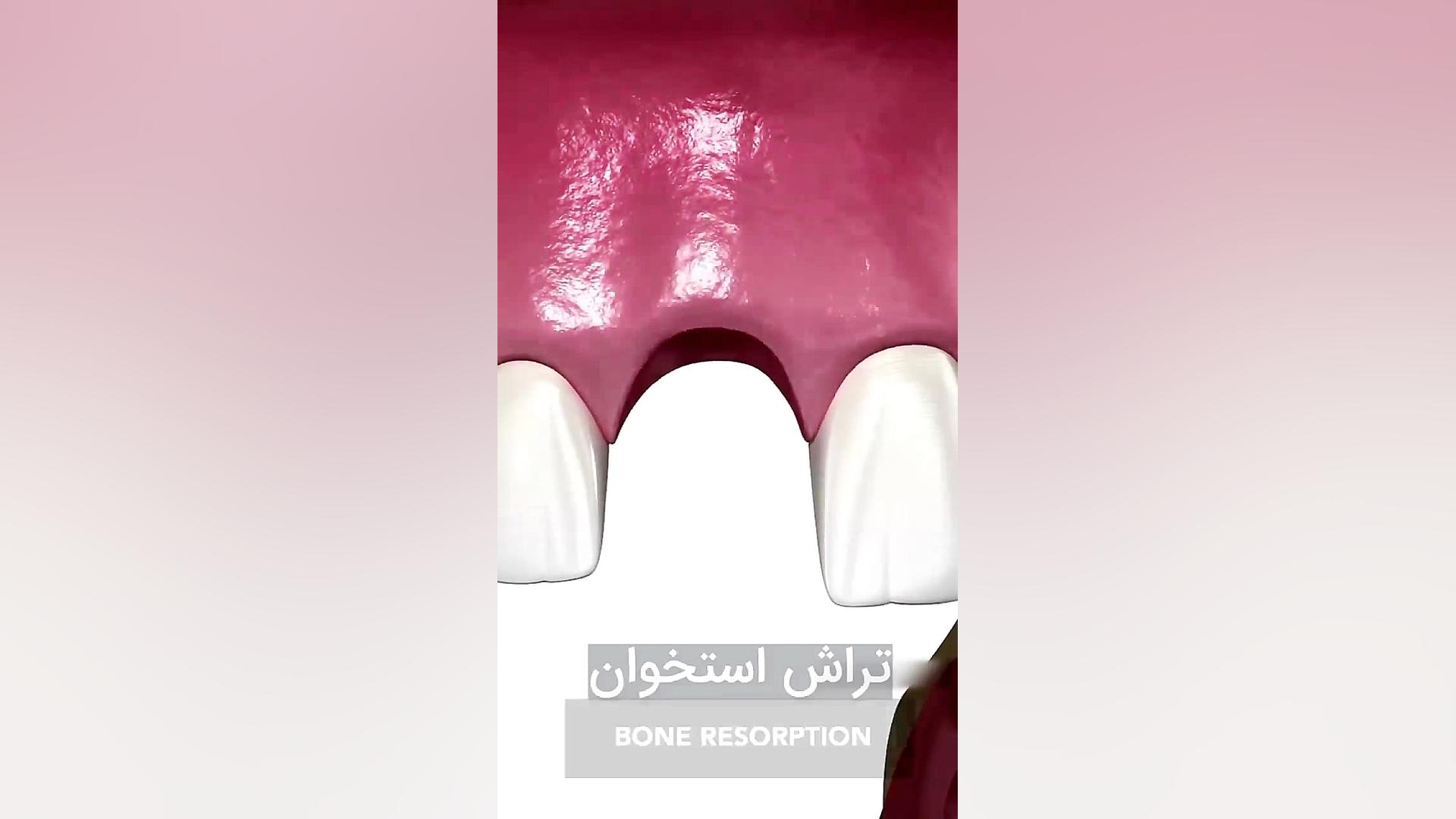 روش کاشت دندان علامت بابینسکی