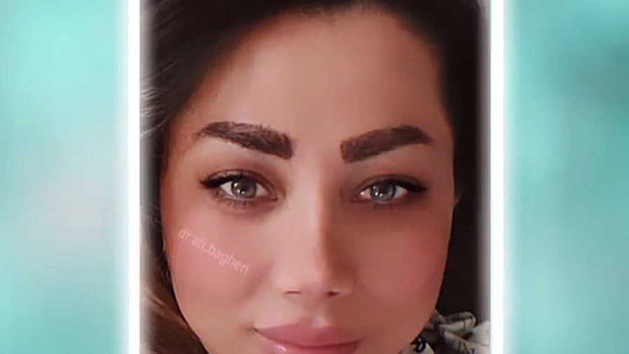 دو سال بعد از جراحی زیبایی بینی دکتر علی باقری حق
