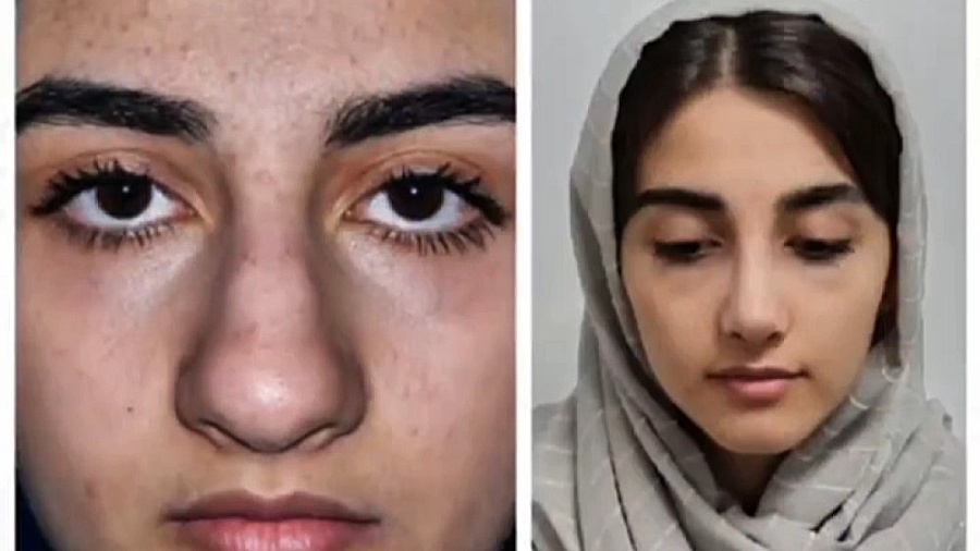جراحی بینی گوشتی با نوک پهن دکتر علی شفیعی رونیزی | بهترین جراح بینی تهران