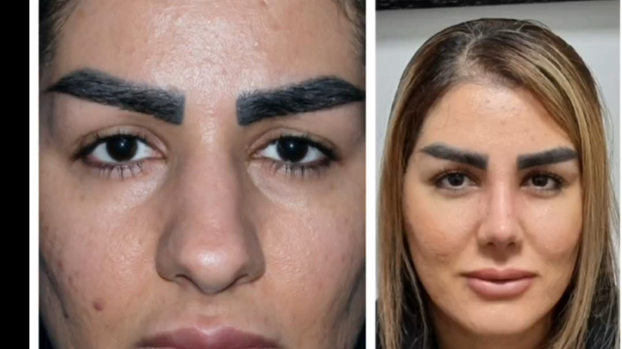 20 روز بعد از عمل بینی دکتر علی شفیعی رونیزی | بهترین جراح بینی تهران