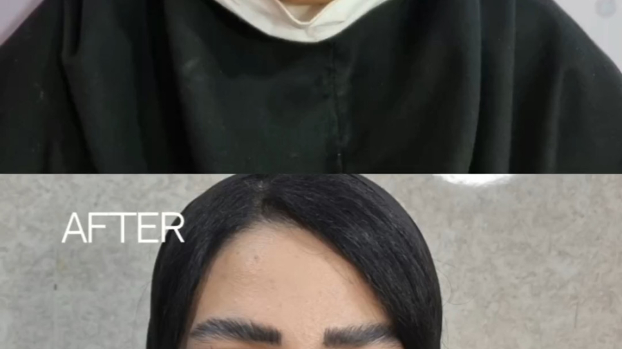 نتیجه عالی از جراحی بینی گوشتی پهن دکتر علی شفیعی رونیزی | بهترین جراح بینی تهران