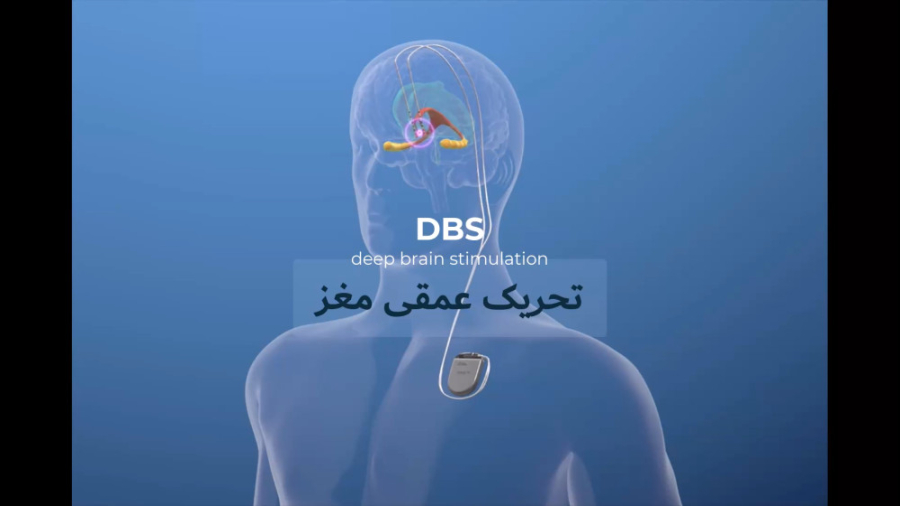 تحریک عمقی مغز DBS جوانسازی پوست