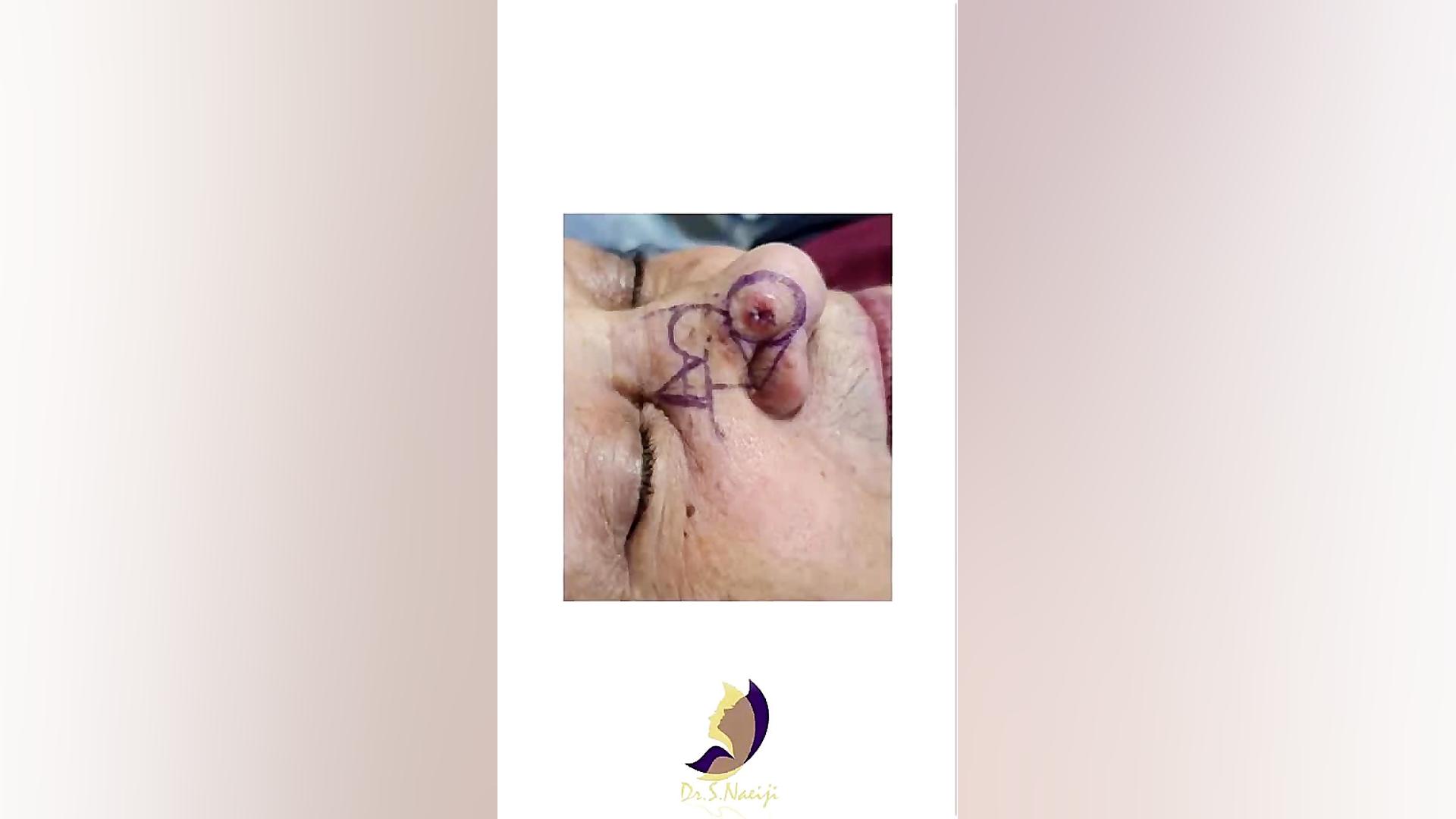جراحی سرطان پوست دکتر صدیقه نائیجی | متخصص پوست و مو در قم