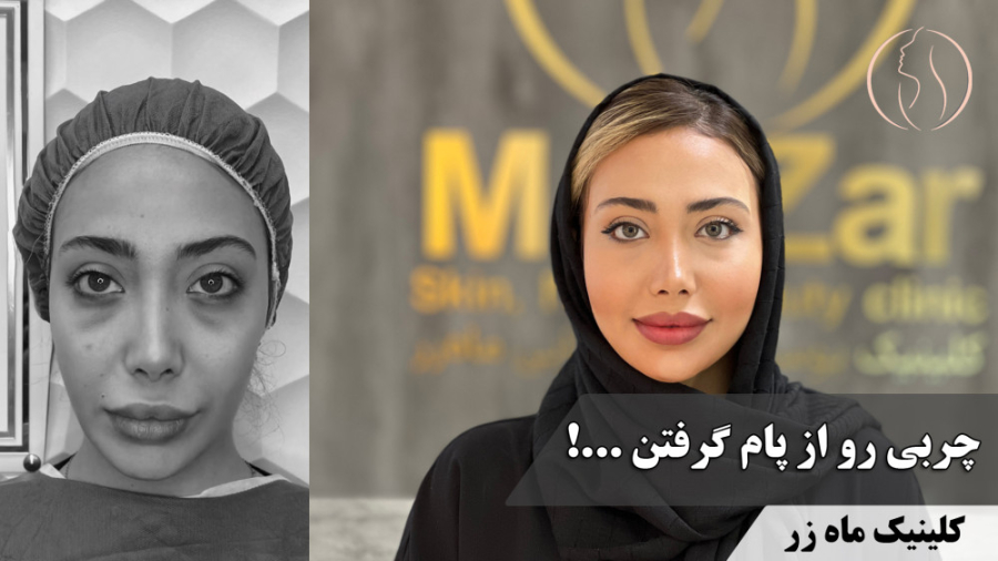 تزریق چربی به روش بایوفت ( کلینیک ماه زر ) سیستم نانواینژکتور