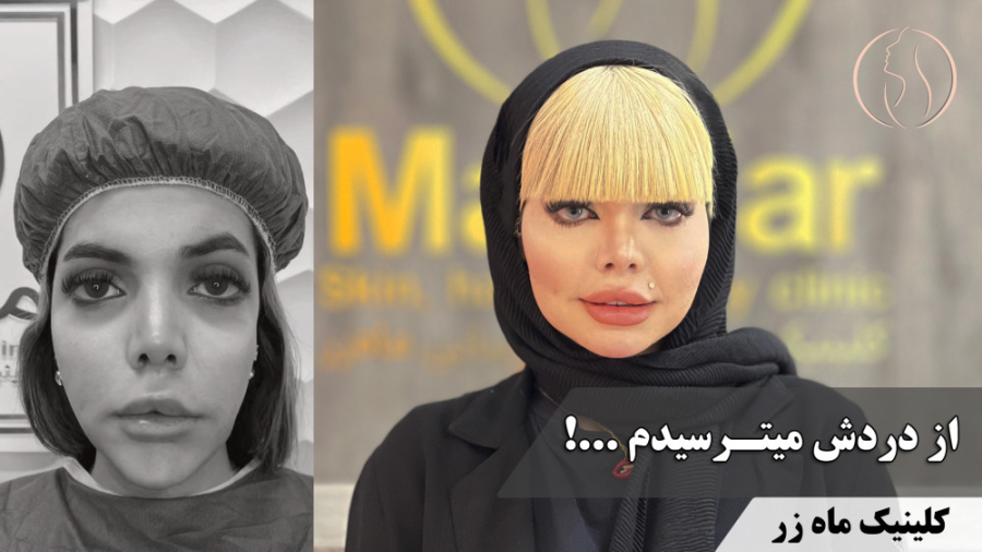 زیبایی طبیعی با تزریق چربی ( کلینیک زیبایی ماه زر ) علامت برودزینسکی