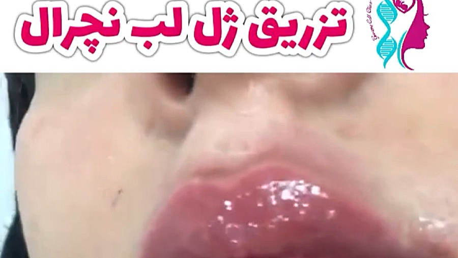 تزریق ژل لب طبیعی اوتیلومیومبر