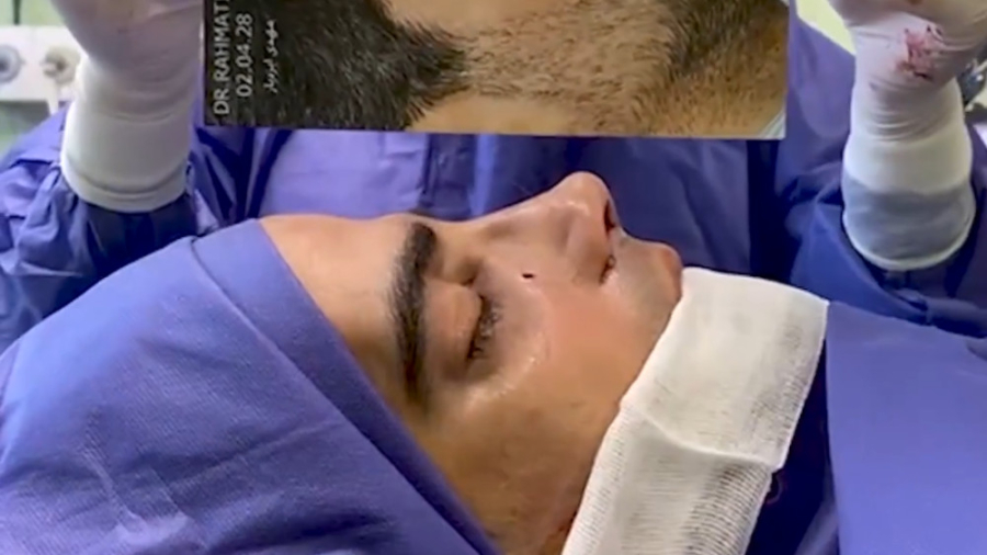 نمونه جراحی رینو پلاستی دکتر جواد رحمتی