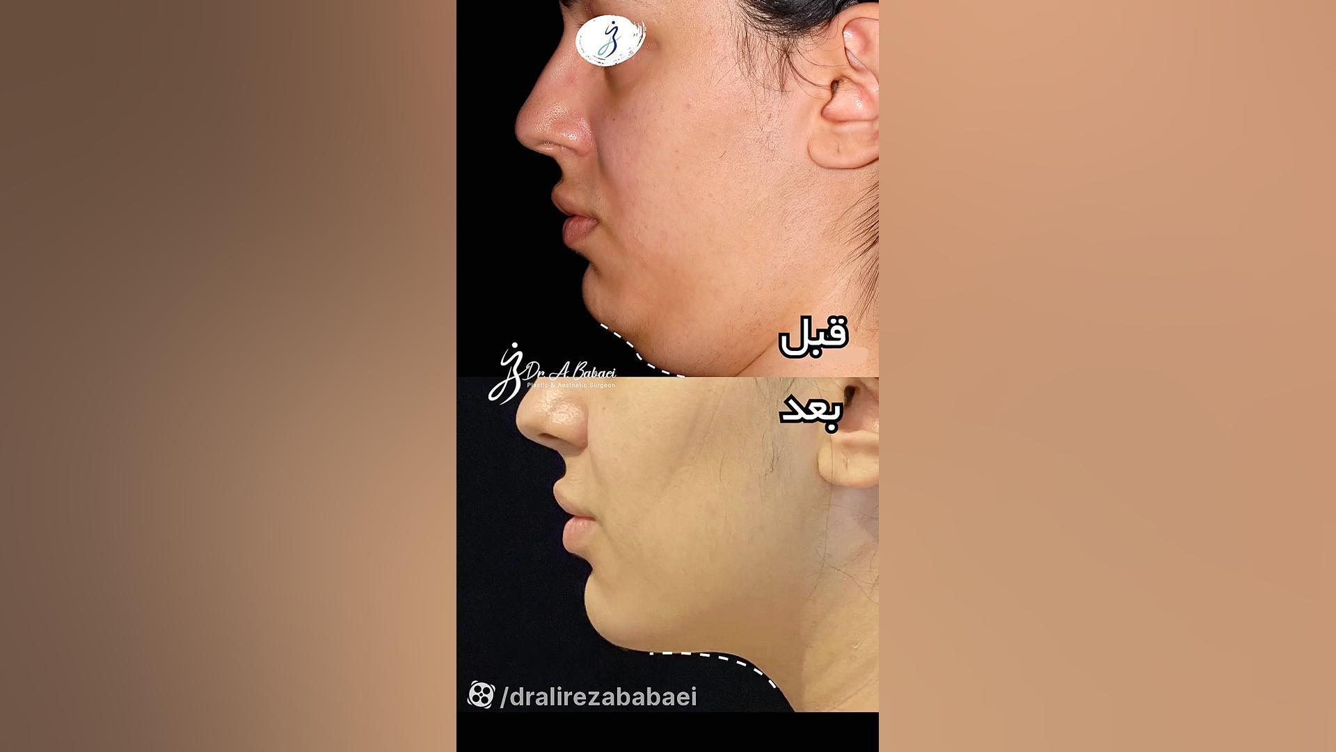 لیپوساکشن غبغب دکتر علیرضا بابایی،فوق تخصص جراحی پلاستیک و زیبایی