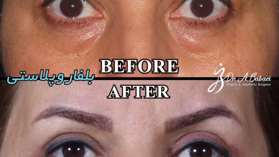 نمونه کار بلفاروپلاستی دکتر علیرضا بابایی،فوق تخصص جراحی پلاستیک و زیبایی