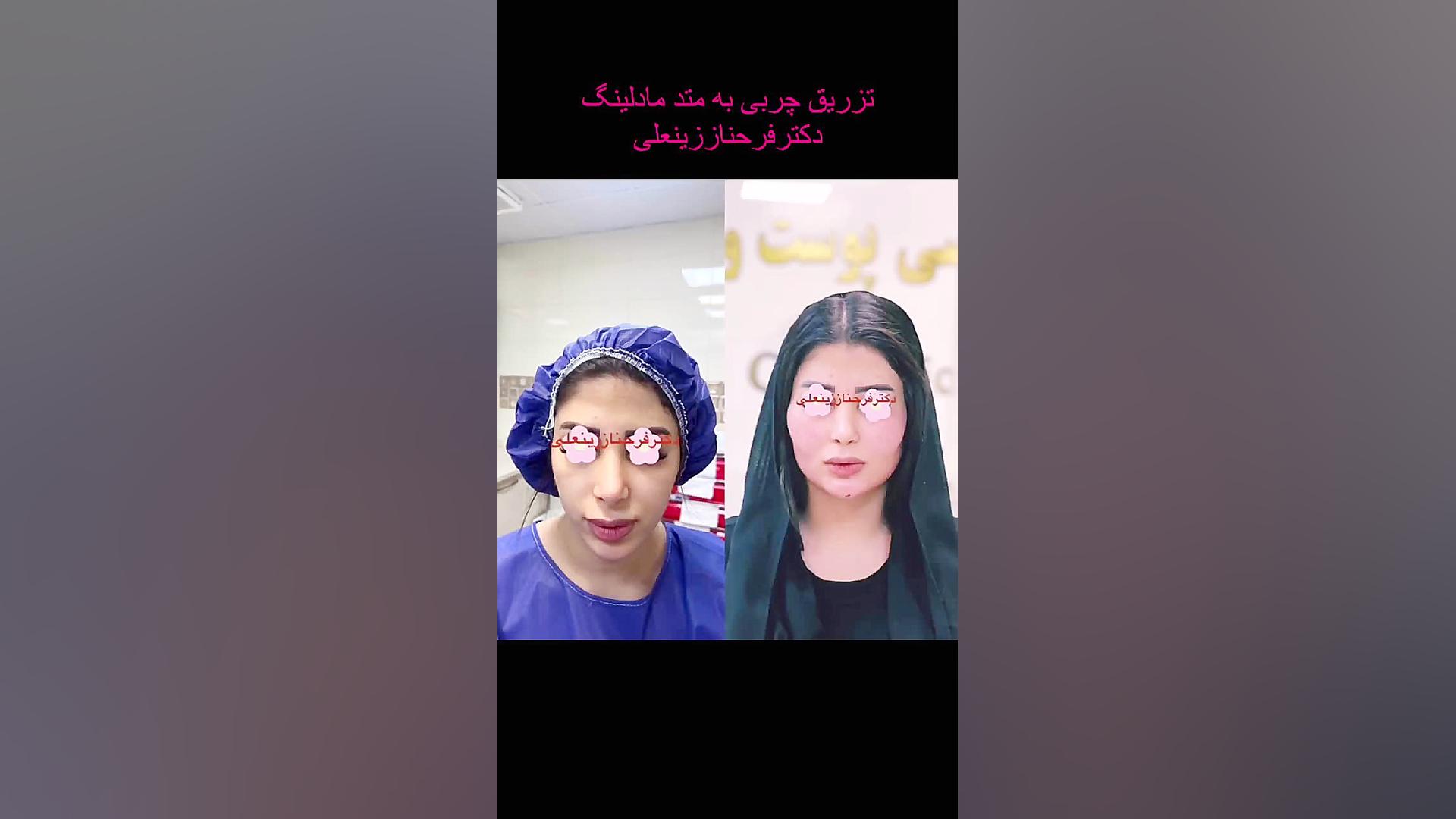 جوانی و زیبایی دائمی با تزریق چربی به گونه ها با ماندگاری بالا دکتر فرحناز زینعلی - متخصص پوست، مو، زیبایی زنجان