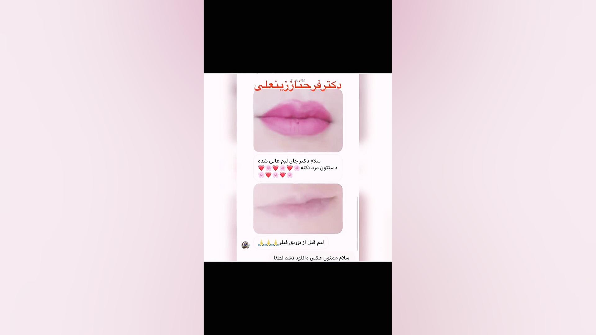 تزریق فیلر لب توسط دکترفرحناززینعلی دکتر فرحناز زینعلی - متخصص پوست، مو، زیبایی زنجان